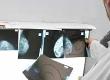 Breast Screening and Implants