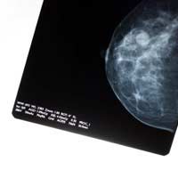 Breast Cancer treating Breast Cancer 