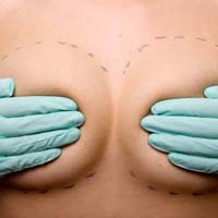Surgery Augmentation Implants Breast
