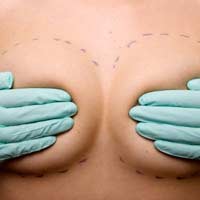 Surgery Augmentation Implants Breast